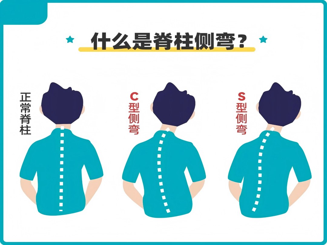 脊柱侧弯科普